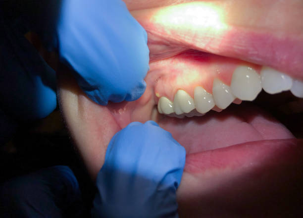 Best Emergency Dental Care for Abscessed Tooth in Firthcliffe, NY